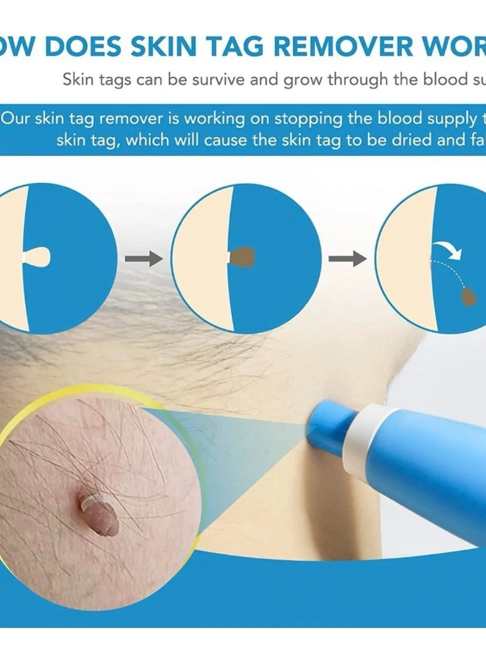 Sefudun Blue Auto Skin Tag Remover Kit used once
